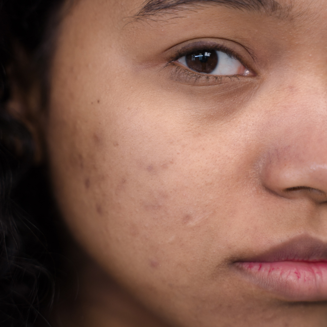 Wave Goodbye to Acne Scars with these Top-notch Tips